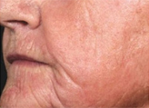 Patient # 92650 After Photo # 2